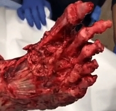 Farmer’s foot gets caught in auger resulting in full skin avulsion