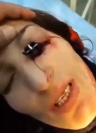 Doctors Removing Knife Lodged In Woman's Eye