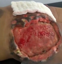 Brazilian butt lift surgery gone wrong