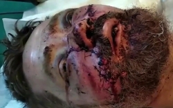 UA Prisoner of War in Russian hospital from Zaporozhian front