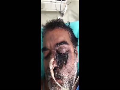 Outbreak of Mucormycosis in India.