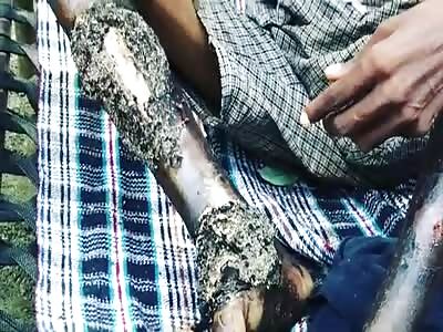 Indian man being eaten by worms.