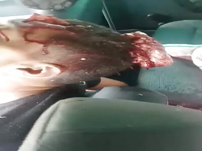 Man has his skull open in accident on BR 101 