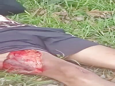 Victim with serious leg injury.