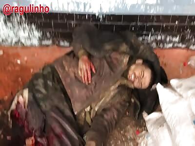 Poor Ukrainian soldier has severed leg