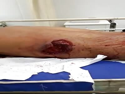  shooting in the rib really hurts