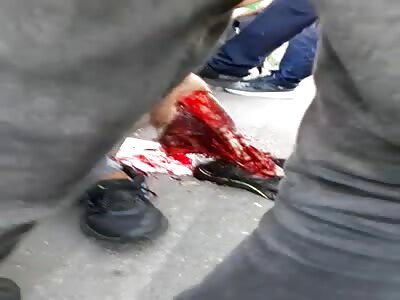  young man with a badly injured leg