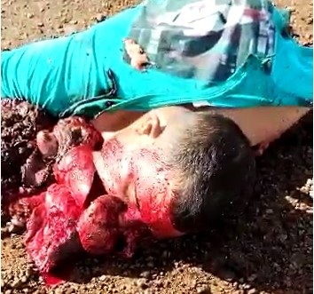 H for horrible accident,body dismembered in accident