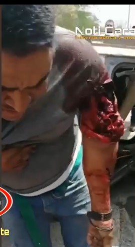 OUCH: Loses Severed Arm in Crush Accident