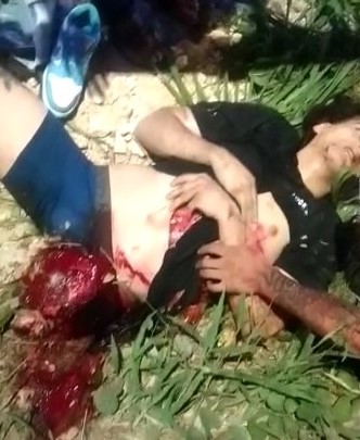 Man in unbearable agony after losing his leg