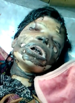 Indian Girl Set Herself on Fire (AFTERMATH)