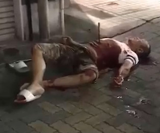 Iron Rod Stabbed into a Man Stomach