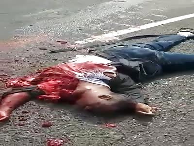 Crushed by truck exposed heart still beating