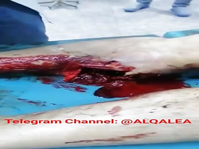 Iraq: shot in the leg (Aftermath)