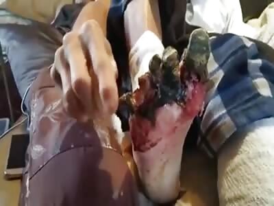 Diabetic man tears off a toe from his necrotic foot.