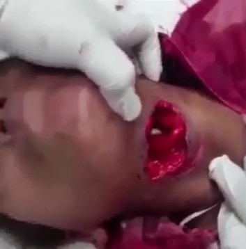 Watch His Throat Moving Through that Hole! (Failed suicide Attempt)