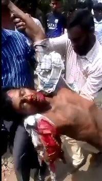 Poor Man Lost an Arm and a Leg in Train Accident 