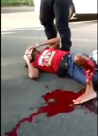 Kid with Gruesome Compound Twisted Fracture still Holding his iPhone 