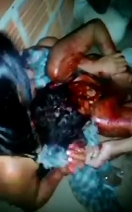 Woman Squirms after Machete Attack took One of her Hands 