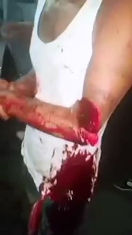 EMT's Work on Man with Arm Sliced from Machete Attack 