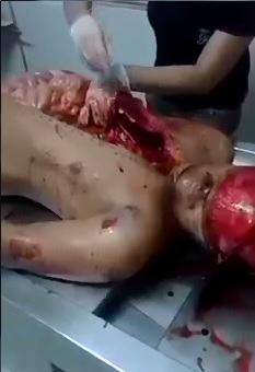 Female Doctor in Plain Clothes doing One of her First Autopsies 