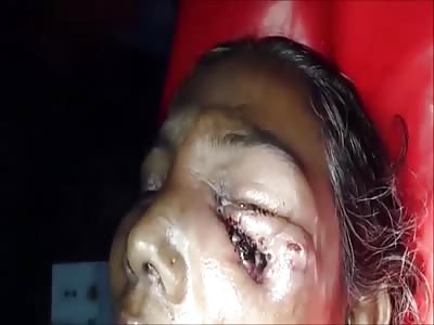 Wound never Healed Right..Maggot Infestation 