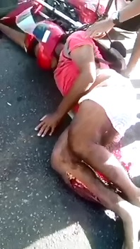 Guy with legs fucked up after accident