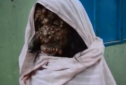Poor Woman has Potato Tumors All Over her Body 
