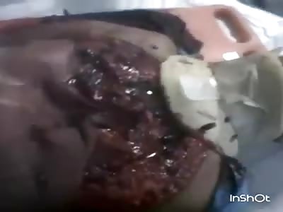 Shocking Open Chest Trauma in the ER 