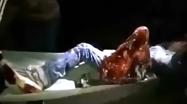 Completely Fucked Up Leg Dangling by Tendons Kid is in Shock 