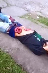 Young Man with Stomach Wound has his Lower Intestines Hanging Out 