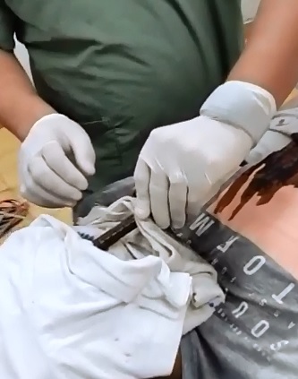 Metal Bar Embedded in the Face..Doctors Working to Get it out 