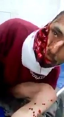 Sit Still...Man's Face almost Gone from Machete Blows to the Head 