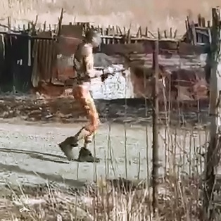 Zombie Man walks around in Shock 3rd Degree Burns All over his Bodt 