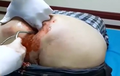 Just an Absolutely Disgusting Video of a Giant Pink Dildo removed from Bloody Ass of a Man 