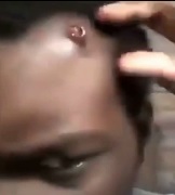 Rock Head.... Bullet Gets Stuck in Mans Forhead