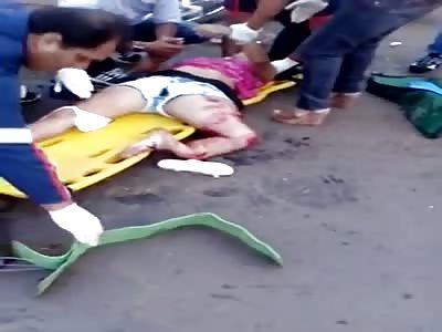 Woman in pain with multi fractured leg after being ran over