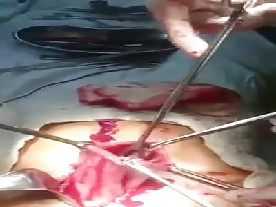 Fucked up Fetish....Man has Several Tooth Brushes Removed from Stomach