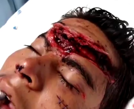 Machete Gash Across his Forehead is Awful