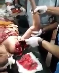 Doctors Keep Moving Woman's Nearly Ripped Off Arm