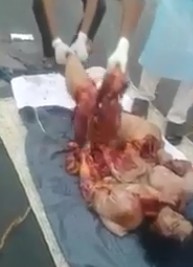 Woman Ripped in Pieces Put Togheter