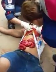 Man in Agony with Intestines Exposed