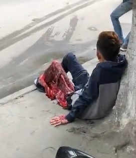HORRIFYING Leg Injury on Kid