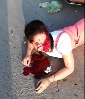 Woman Loses Half Her Face .