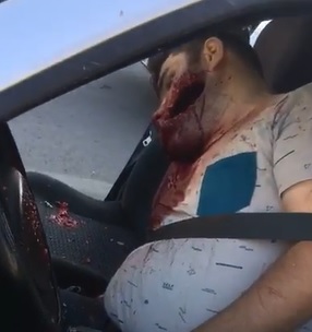 Dude Shot Through he Jaw...Huge Face Hole