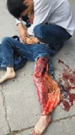 Leg Literally Ripped to Shreds