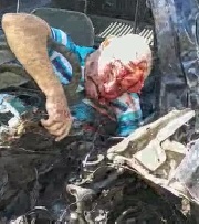 Man Scalped from Horrific Accident