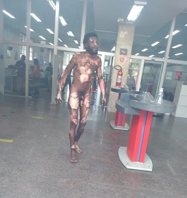 Sizzling Man Still Smoking after BBQ.. Skin Falling Off (longer version).