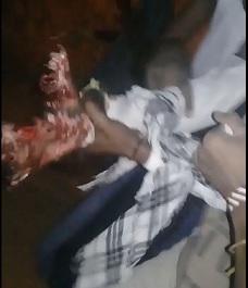 Explosive Device Turned His Hand into Crab Claw.