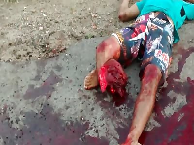 Terrible motorcycle accident open fracture